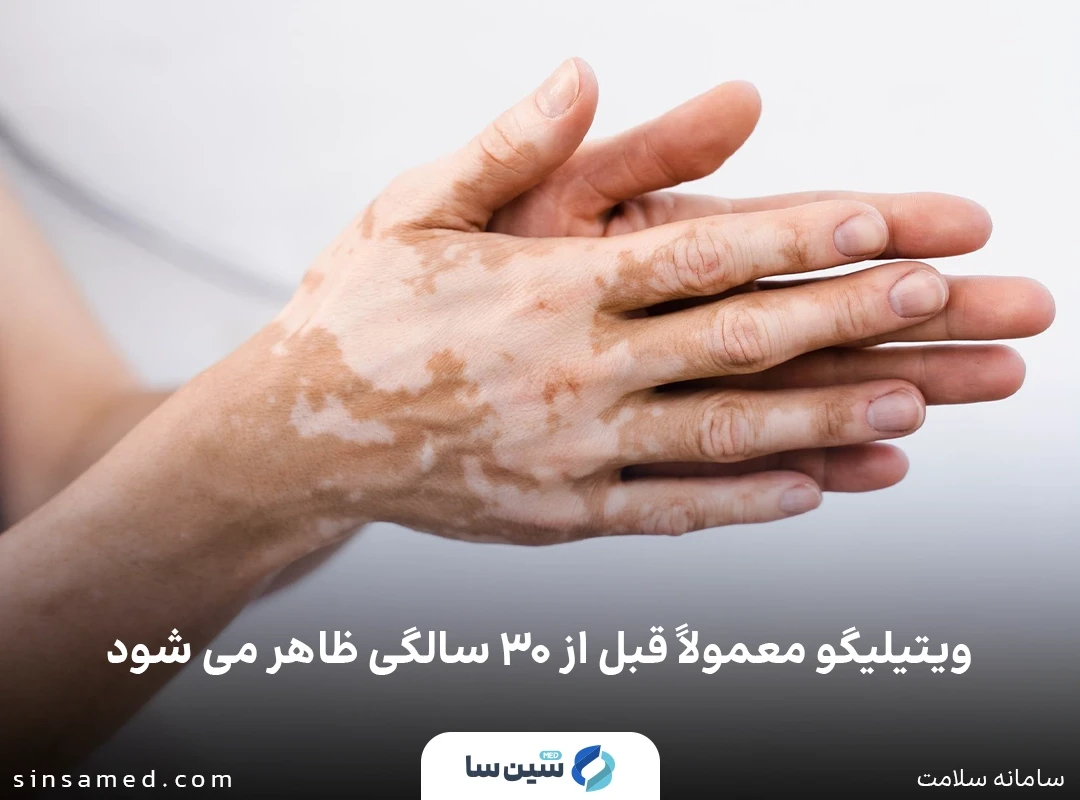 نشانه ها و علائم ویتیلیگو (پیسی)