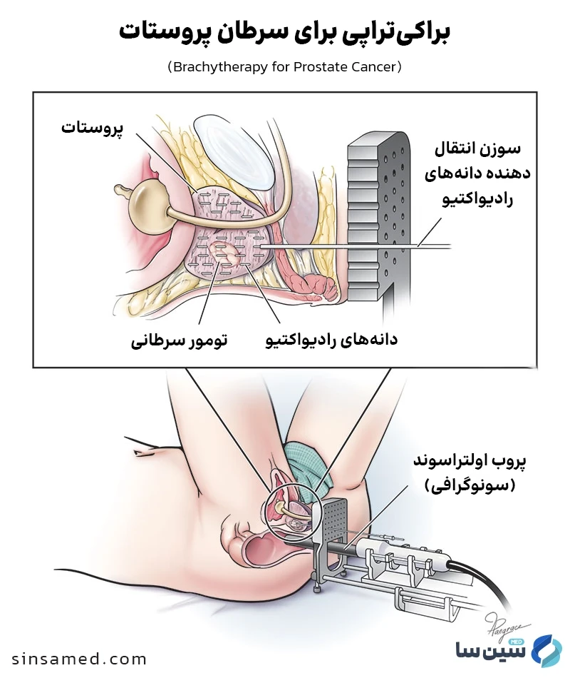براکی تراپی (Brachytherapy) 
