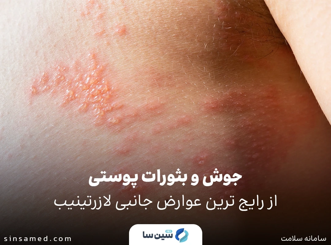 جوش و بثورات پوستی از رایج ترین عوارض جانبی لازرتینیب