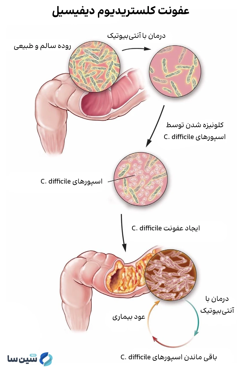 چرخه عفونت ناشی از کلستریدیوم دیفیسیل
