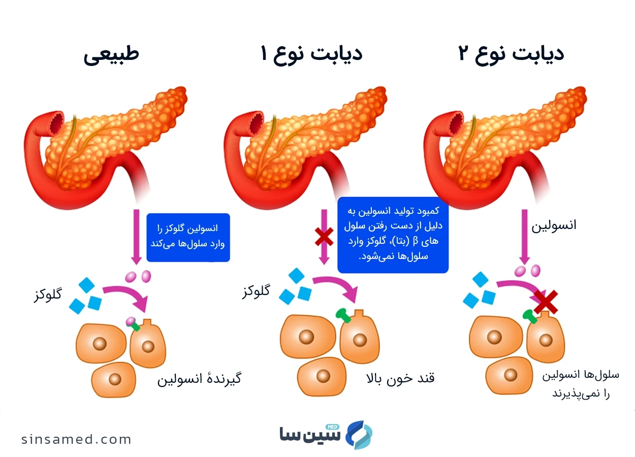 مقایسه دیابت نوع 1 و 2 با حالت سالم