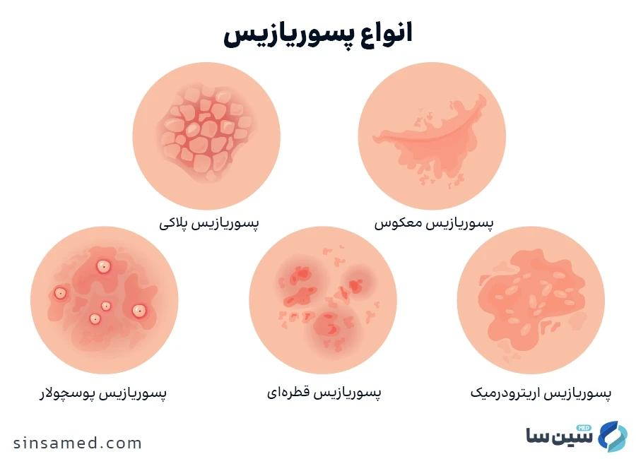 انواع پسوریازیس