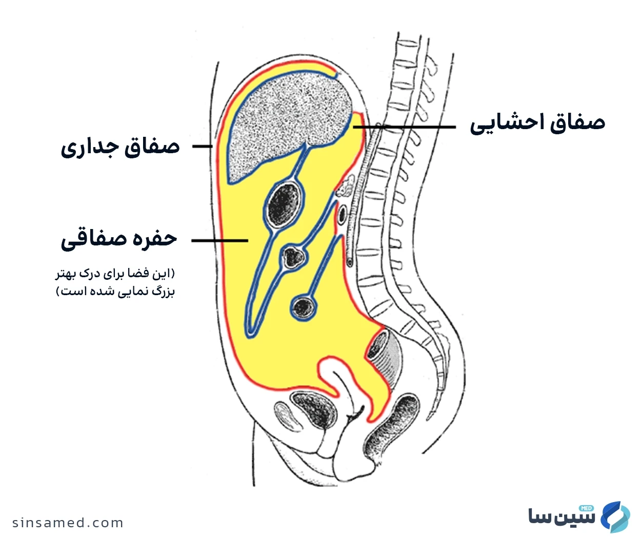 سرطان های شکمی از علل ابتلا به کارسینوماتوز صفاقی