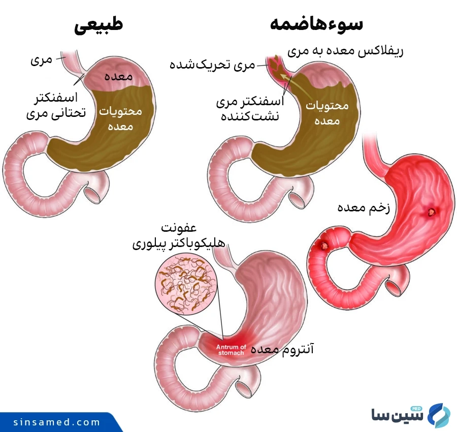 سوء هاضمه و حالت طبیعی معده