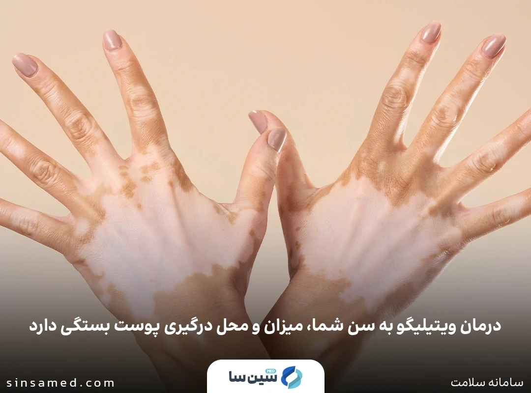 درمان ویتیلیگو به سن شما، میزان و محل درگیری پوست بستگی دارد