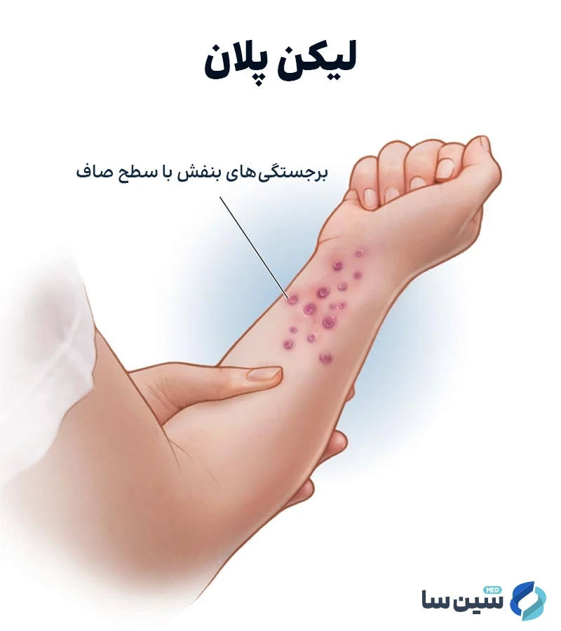 بروز لکه های پوستی ازعوارض ابتلا به لیکن پلان