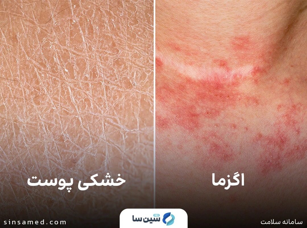 تفاوت خشکی پوست و اگزما