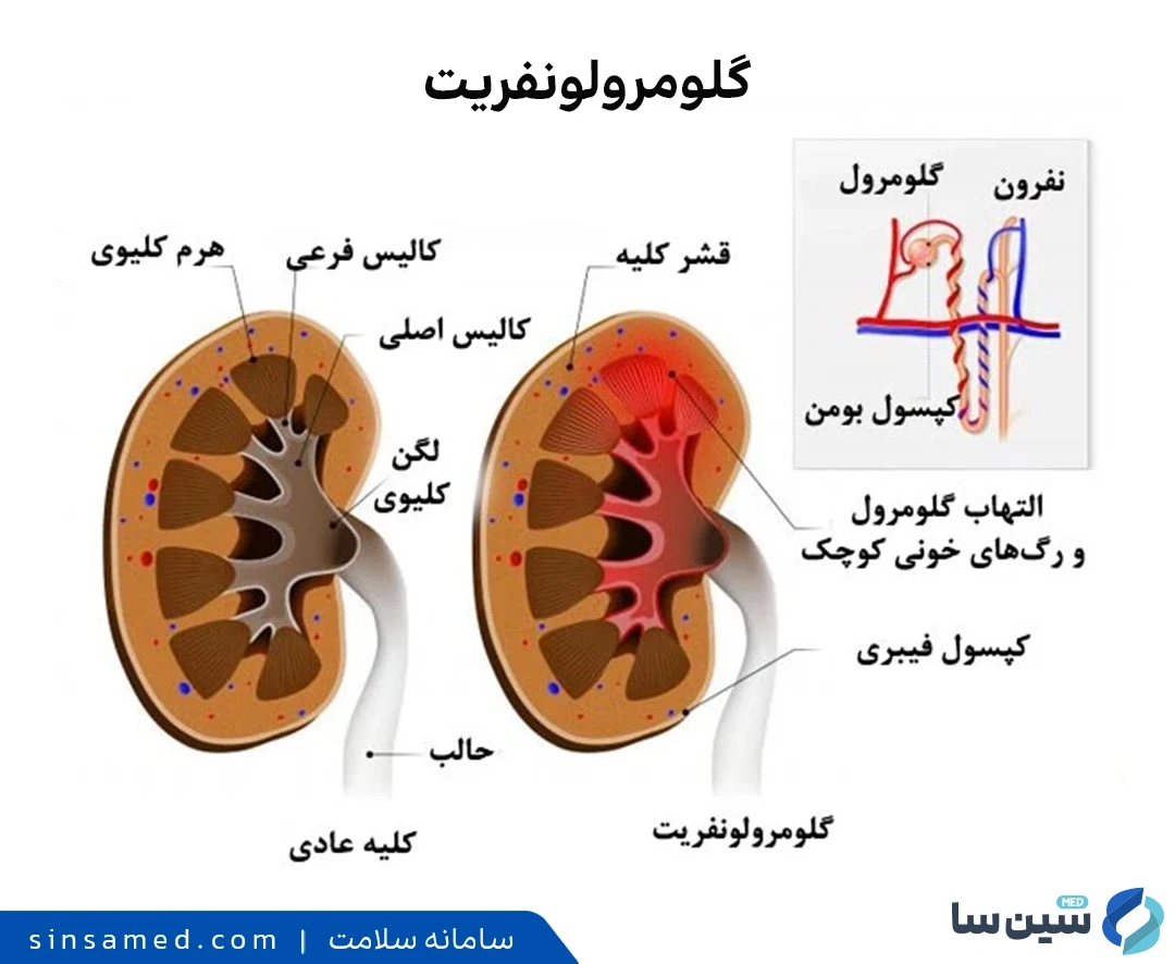 علل ابتلا به گلومرولونفریت