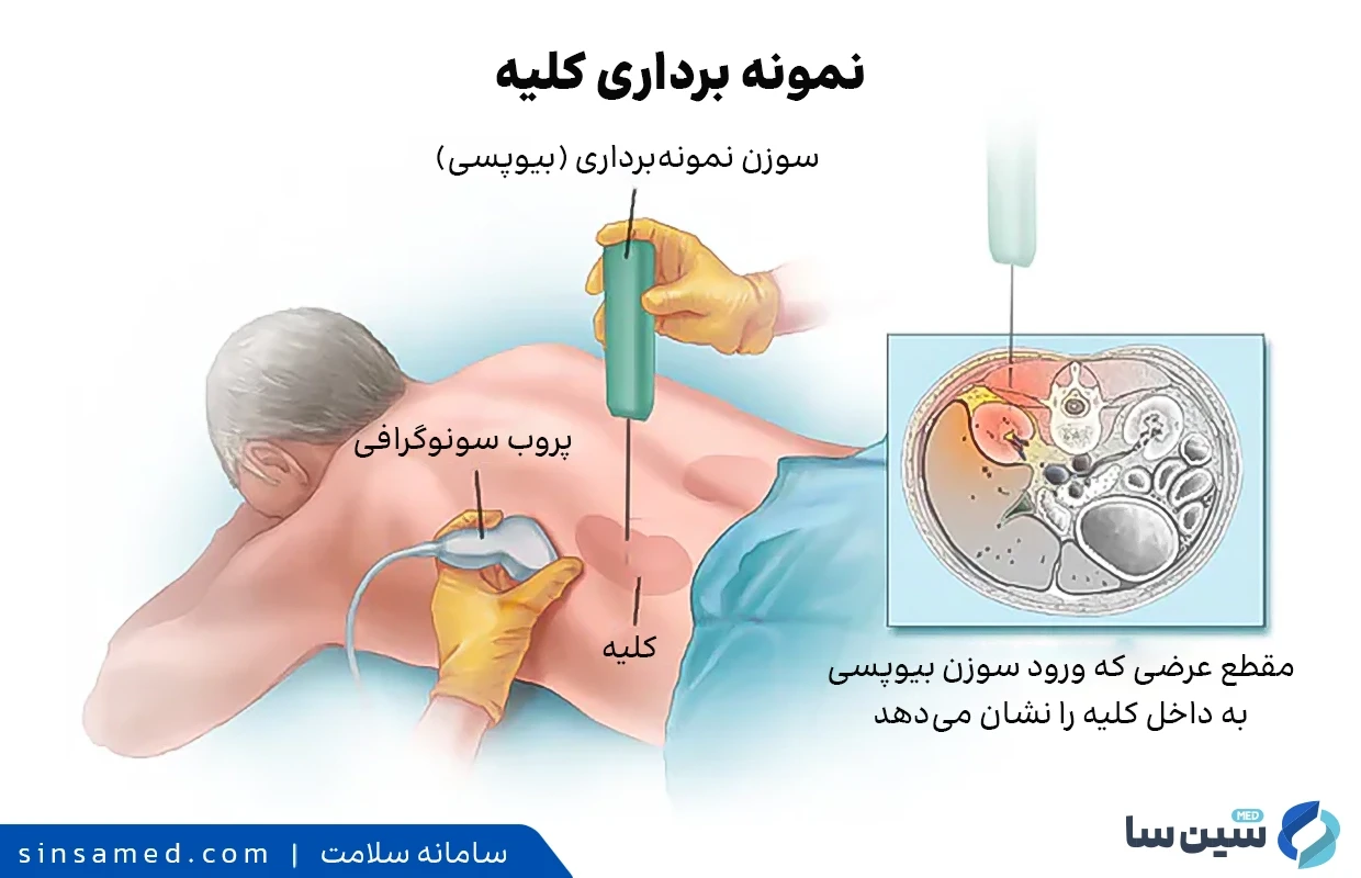 تشخیص گلومرولونفریت با نمونه برداری کلیه