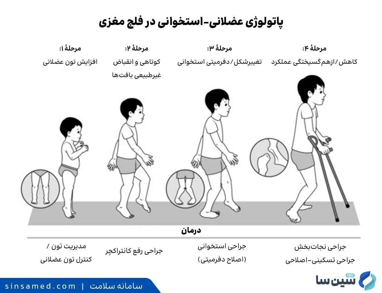 پاتولوژی عضلانی&ndash;استخوانی در فلج مغزی