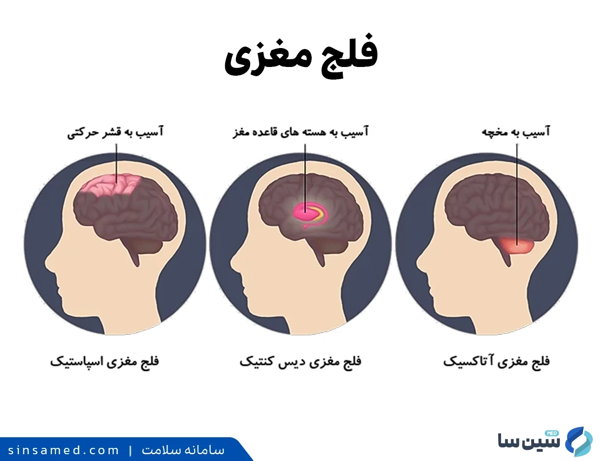 انواع فلج مغزی