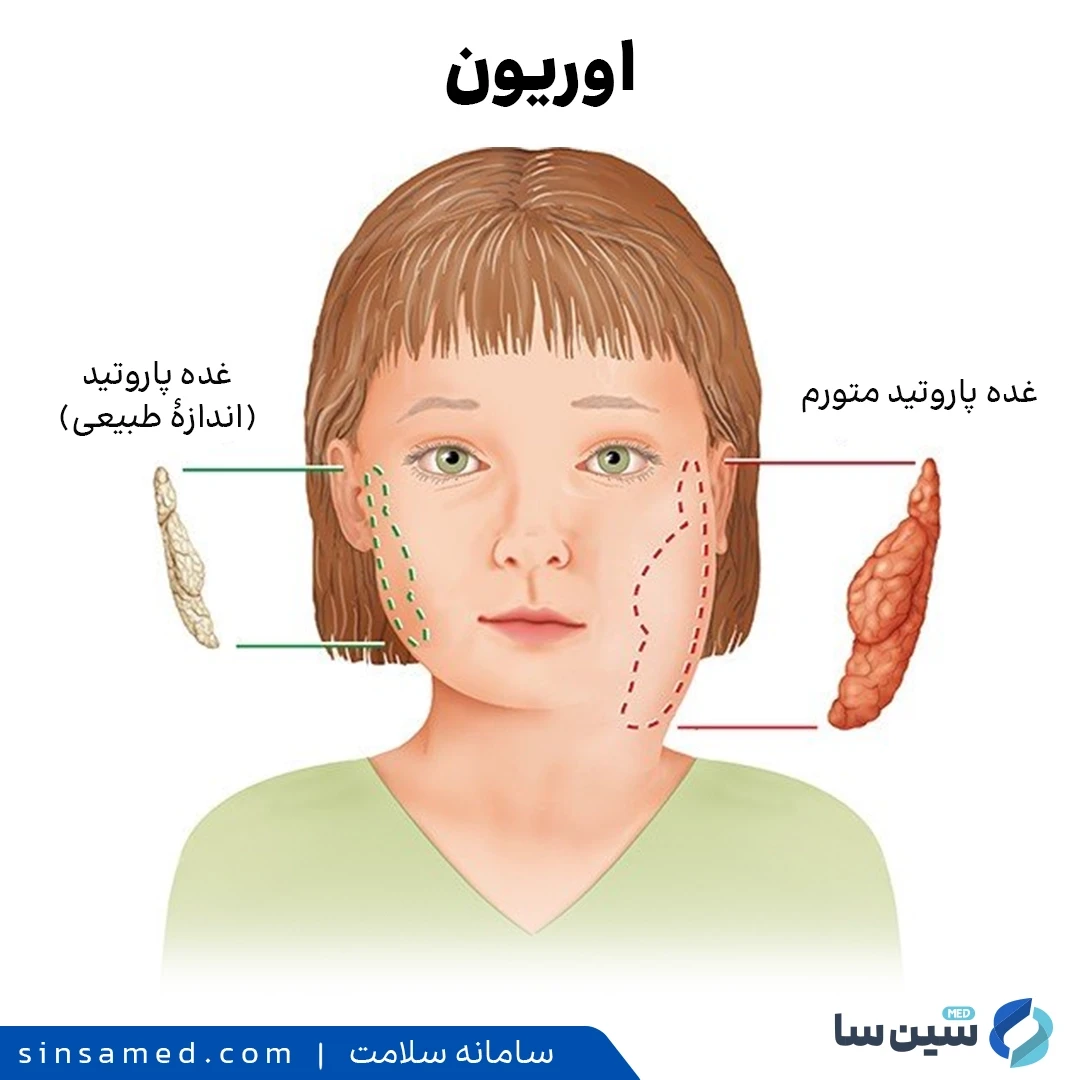تورم غده های بناگوشی از علائم ابتلا به اوریون