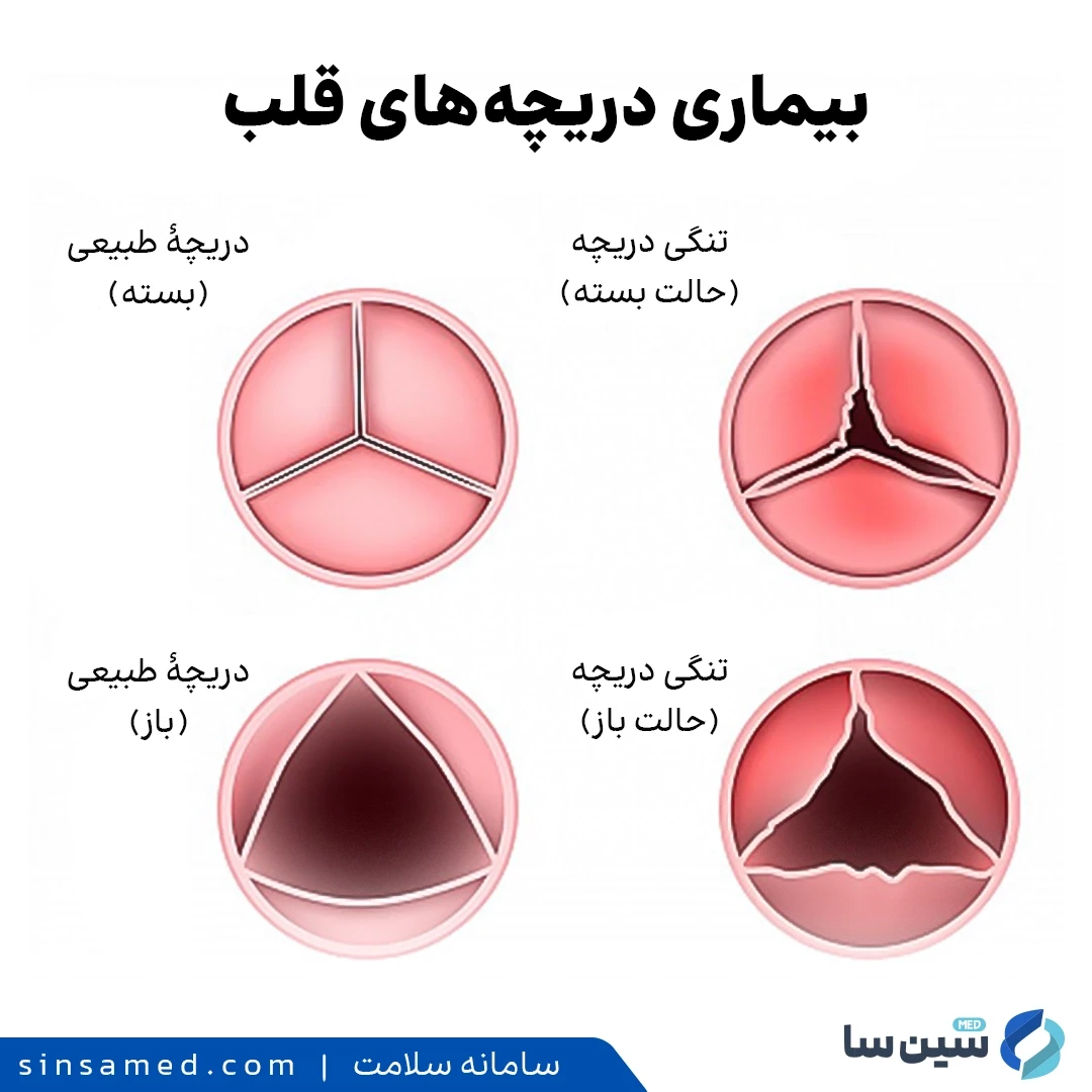 ابتلا به سوفل قلب در نتیجه مشکلات دریچه های قلب
