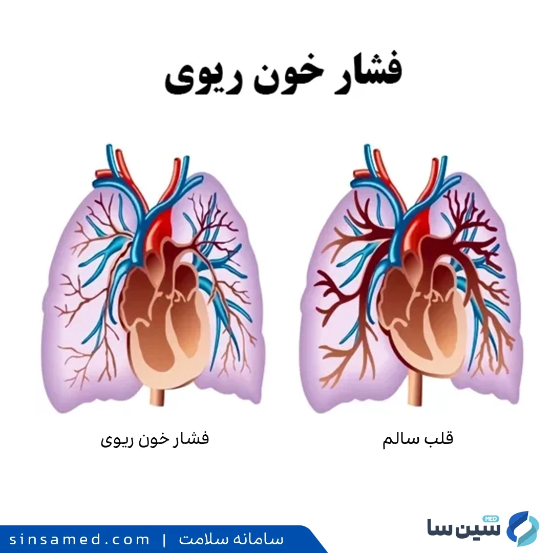 پیشگیری از سوفل قلب با مدیریت یا درمان فشار خون ریوی