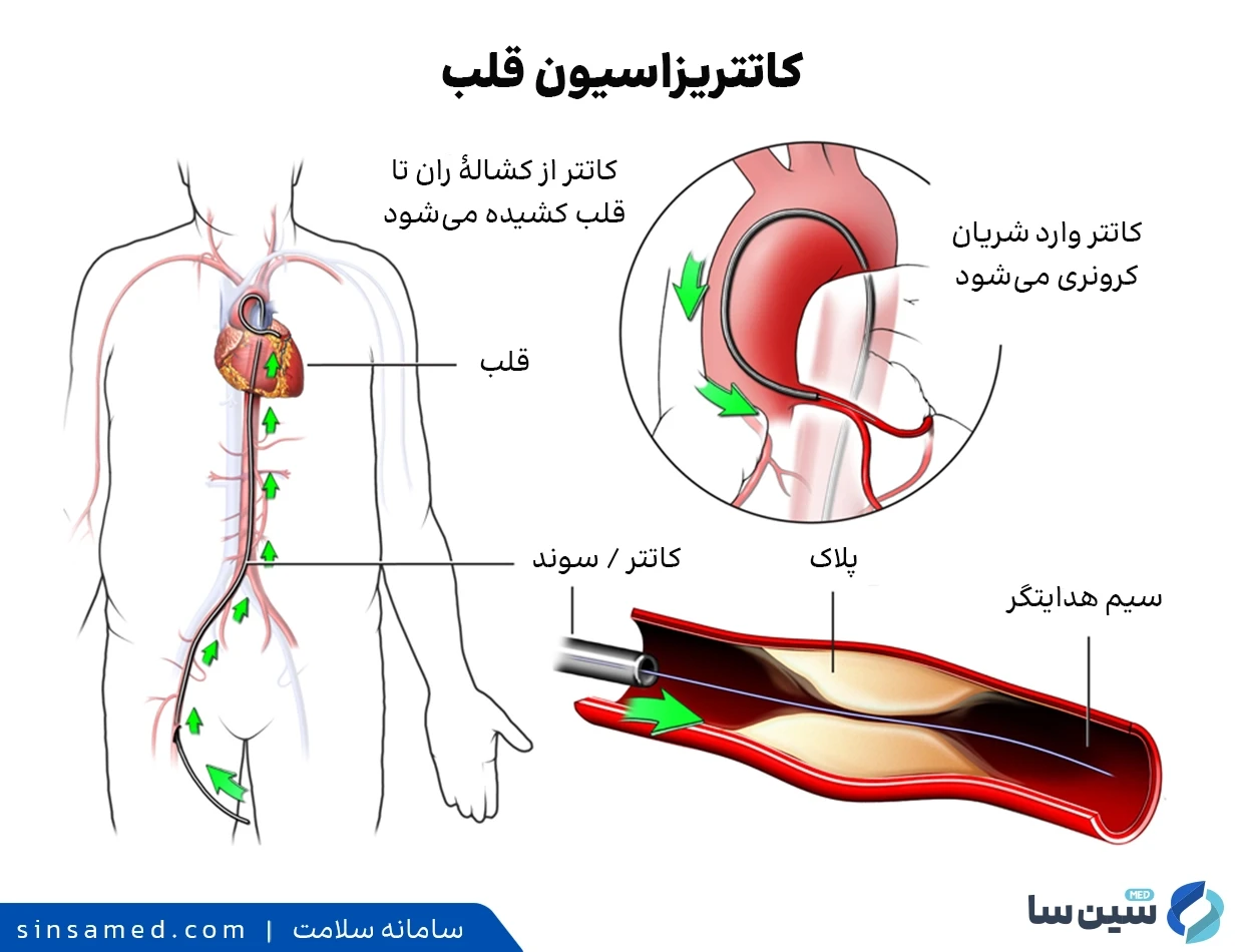 تشخیص سوفل قلب با کاتتریزاسیون قلب