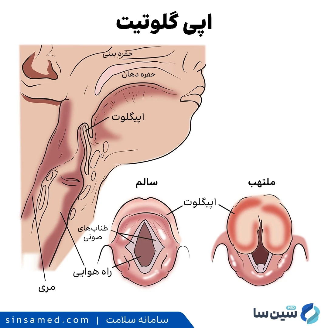 تفاوت اپی گلوت سالم و اپی گلوت ملتهب