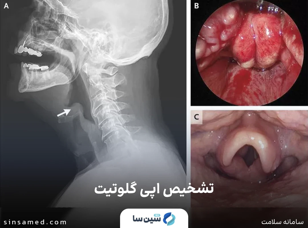روش های تشخیص اپی گلوتیت