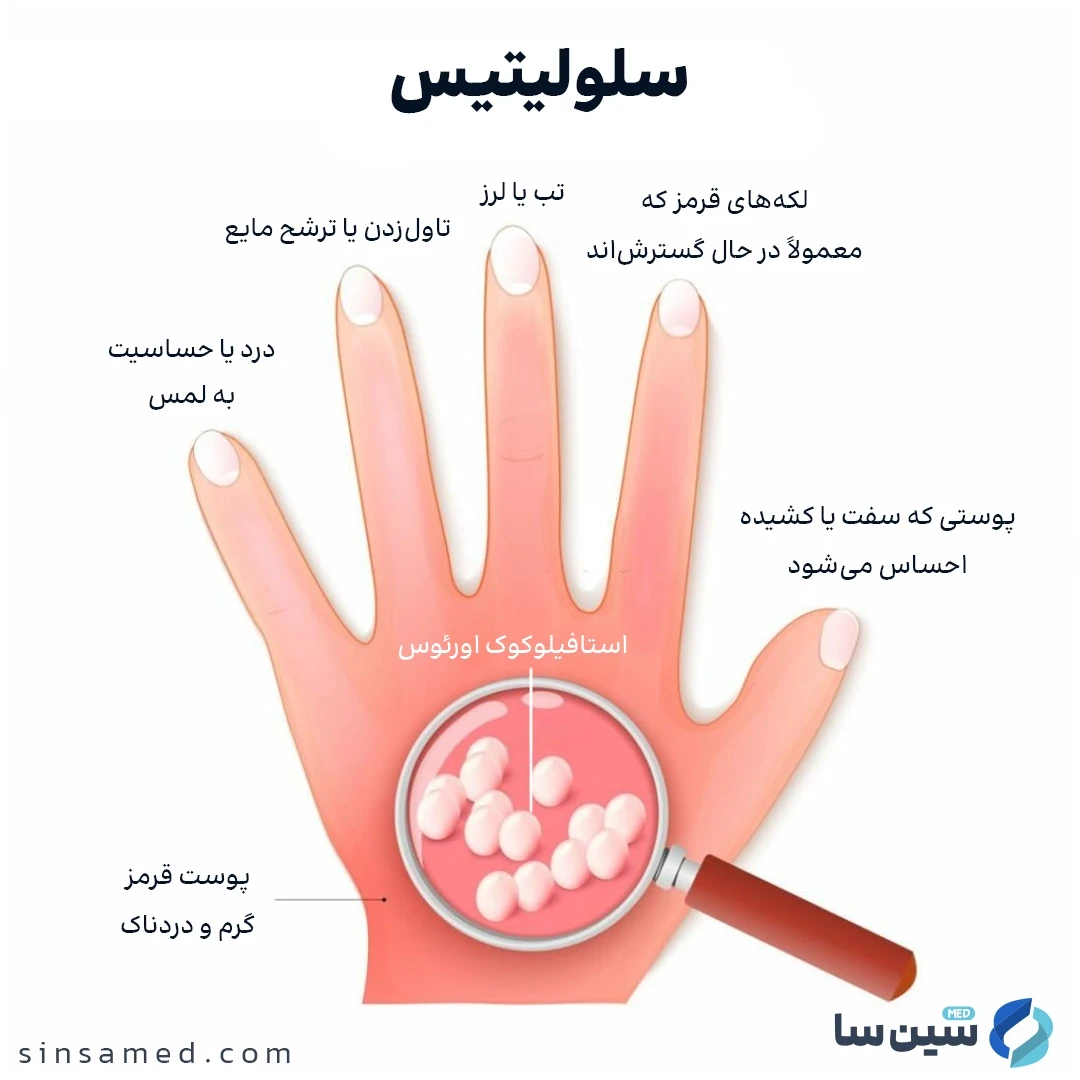 علائم سلولیتیس (التهاب بافت)