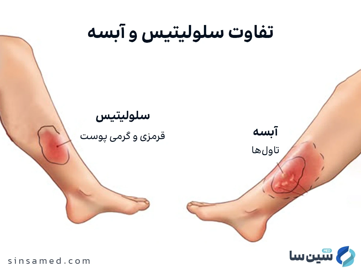 تفاوت سلولیتیس و آبسه