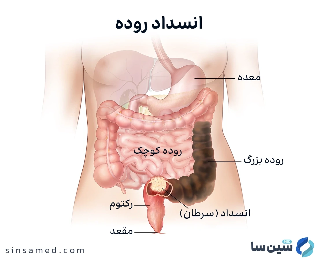 سرطان روده از عوامل خطرساز انسداد روده