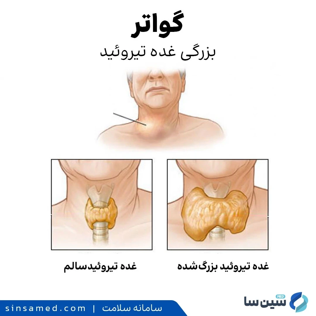 گواتر - بزرگی غده تیروئید در نتیجه کمبود ید