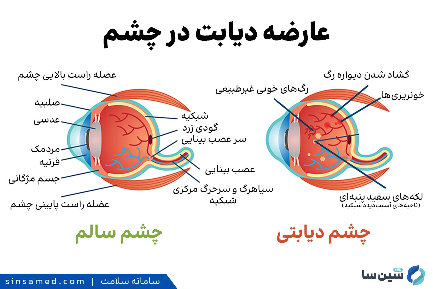 عارضه دیابت در چشم