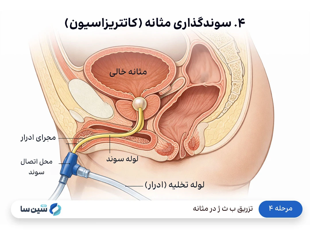 مرحله ۴ تزریق ب ث ژ در مثانه: سوندگذاری مثانه (کاتتریزاسیون)