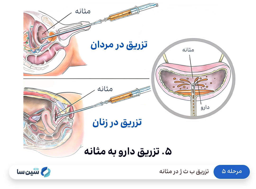 مرحله ۵ تزریق ب ث ژ در مثانه: تزریق دارو به مثانه (Intravesical Instillation)