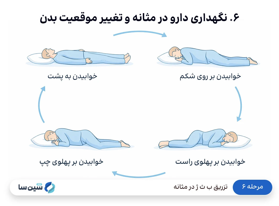 مرحله ۶ تزریق ب ث ژ در مثانه: نگهداری دارو در مثانه و تغییر موقعیت بدن
