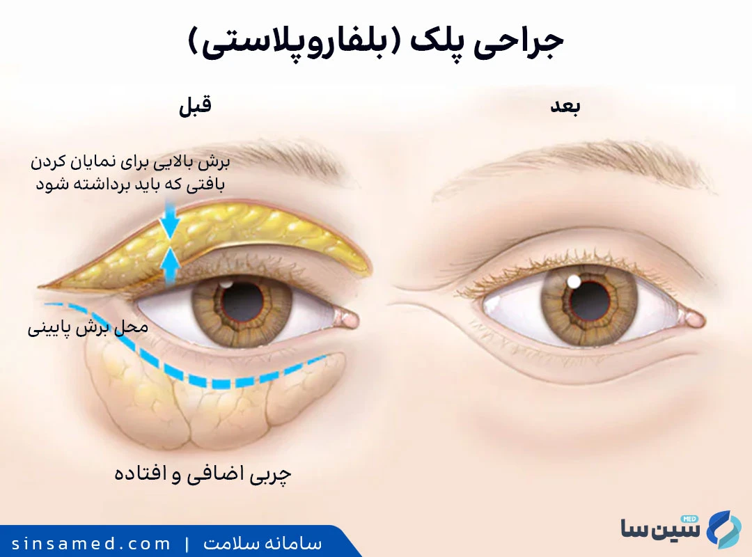 جراحی پلک (بلفاروپلاستی)