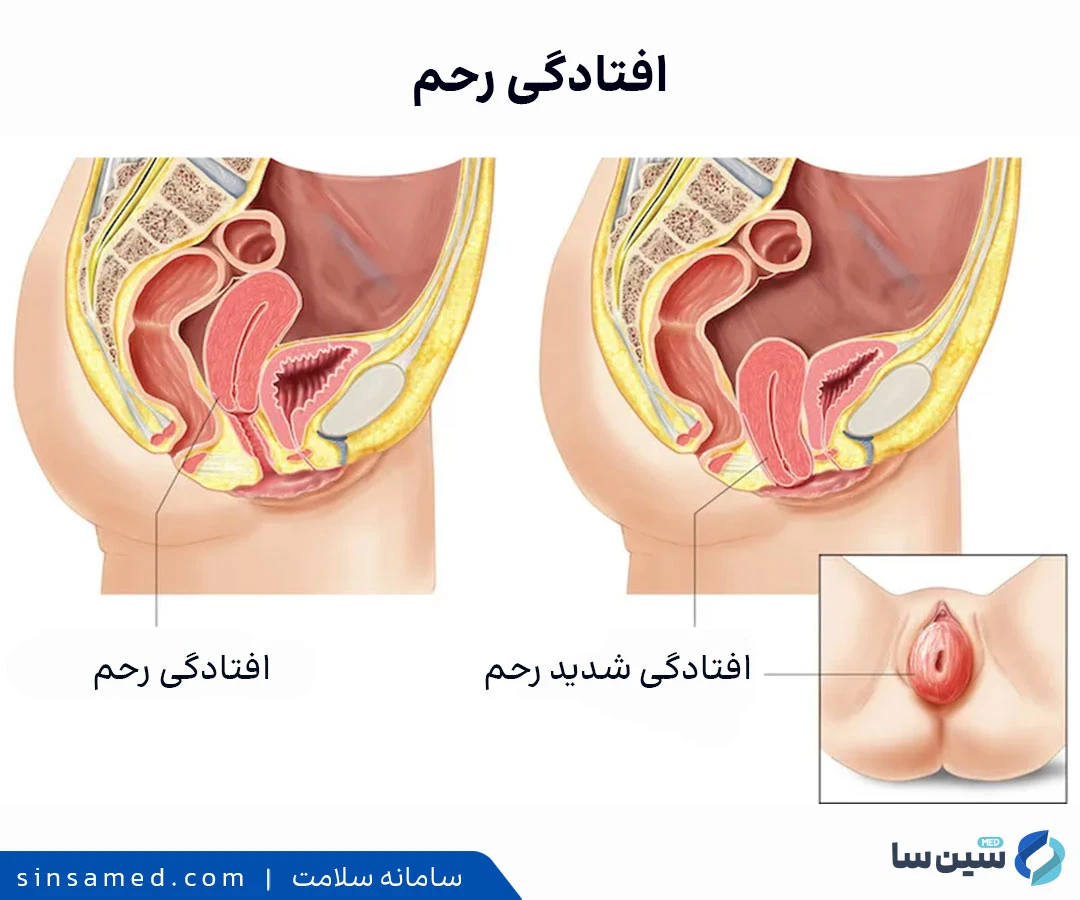 افتادگی رحم و افتادگی شدید رحم