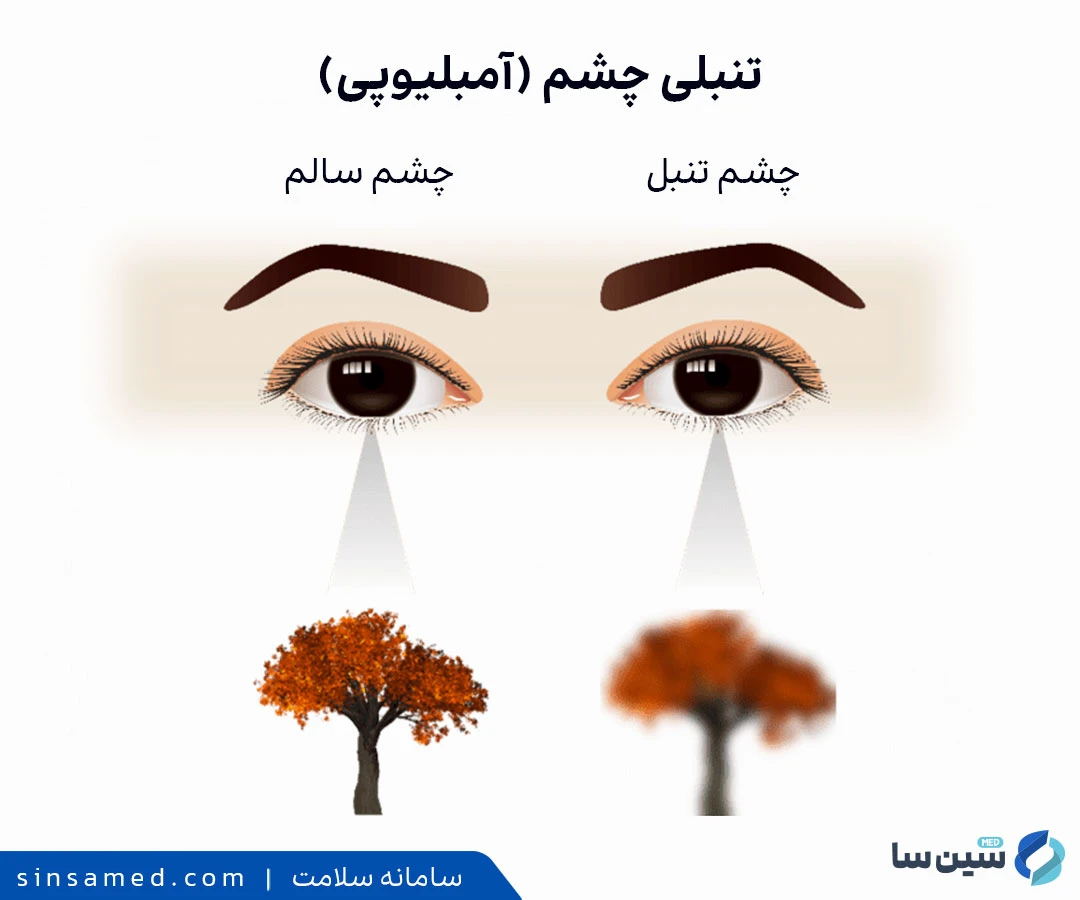 تفاوت چشم سالم و چشم تنبل