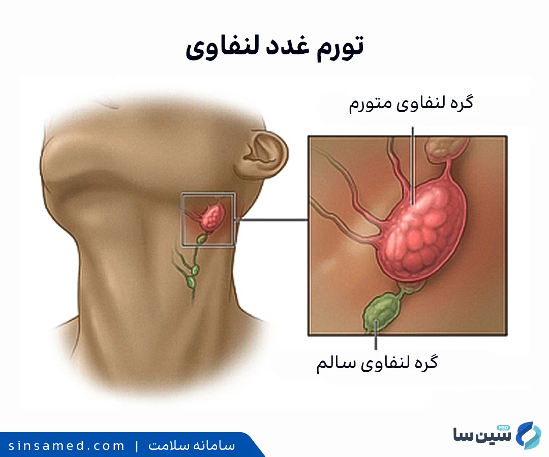 تورم غدد لنفاوی