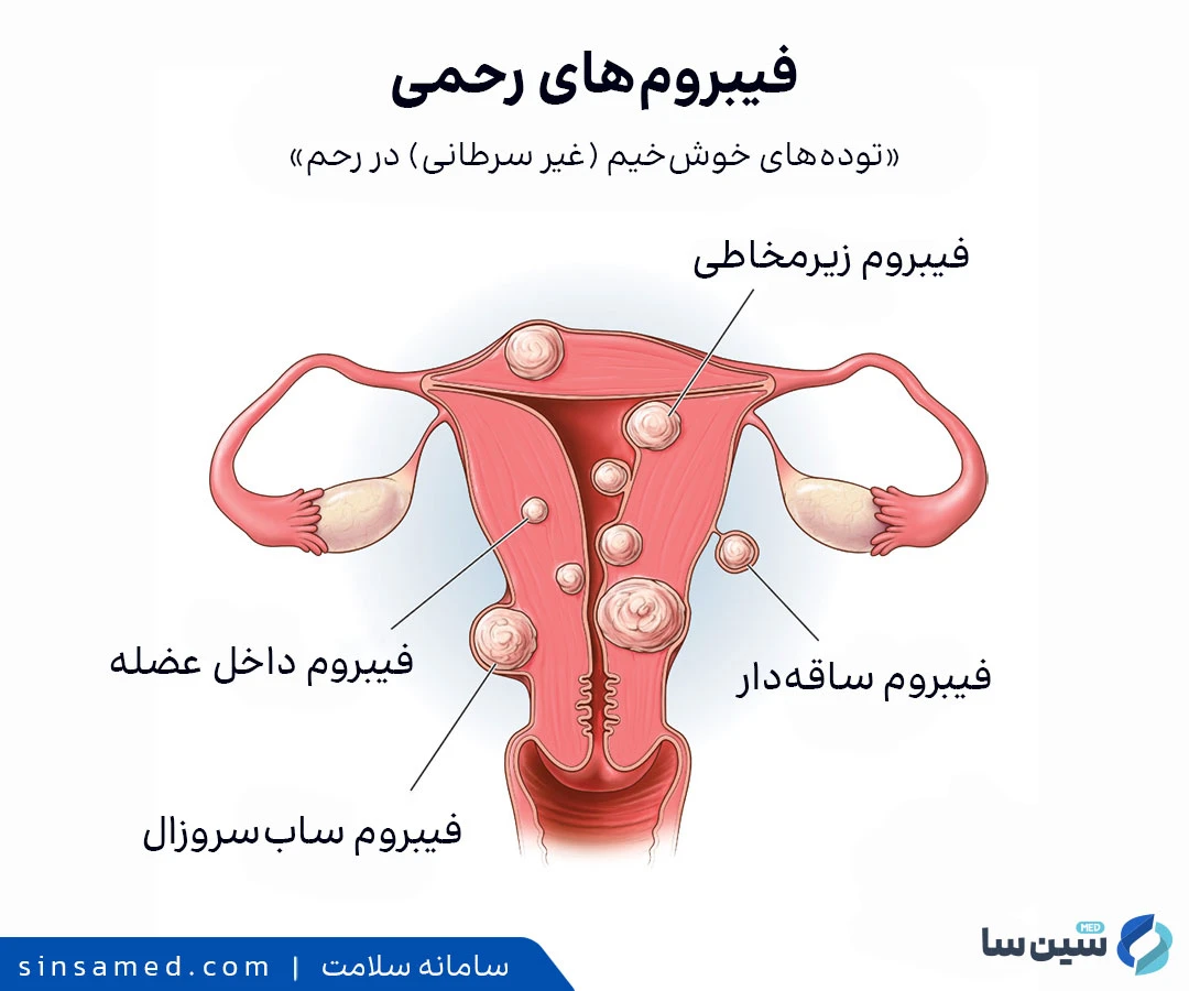 انواع فیبروم های رحمی