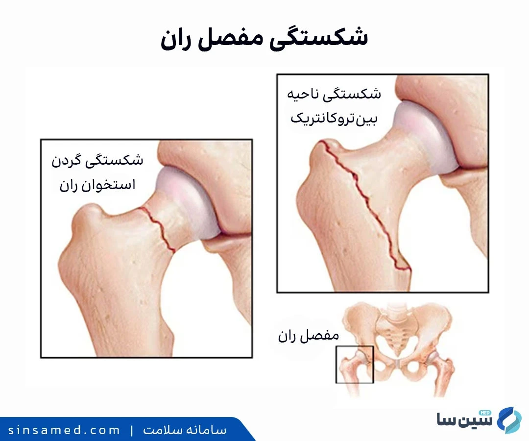 انواع شکستگی مفصل ران 