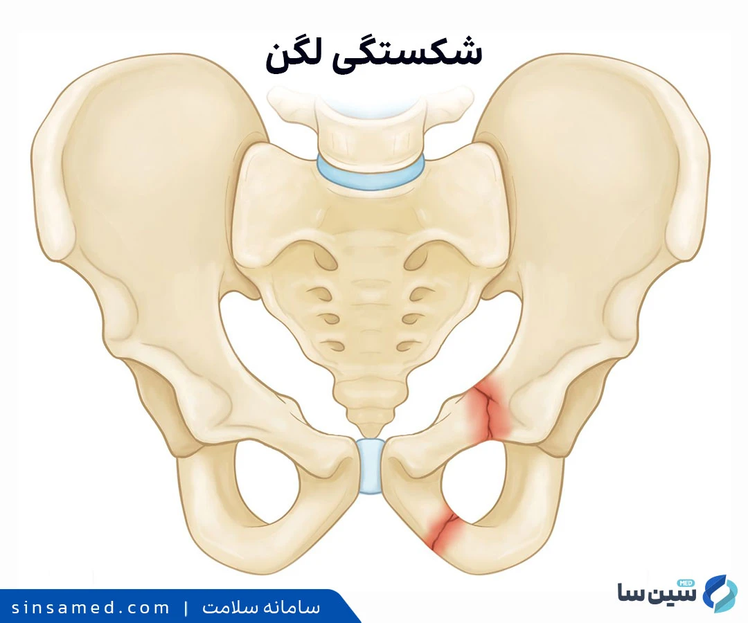 علائم شکستگی لگن