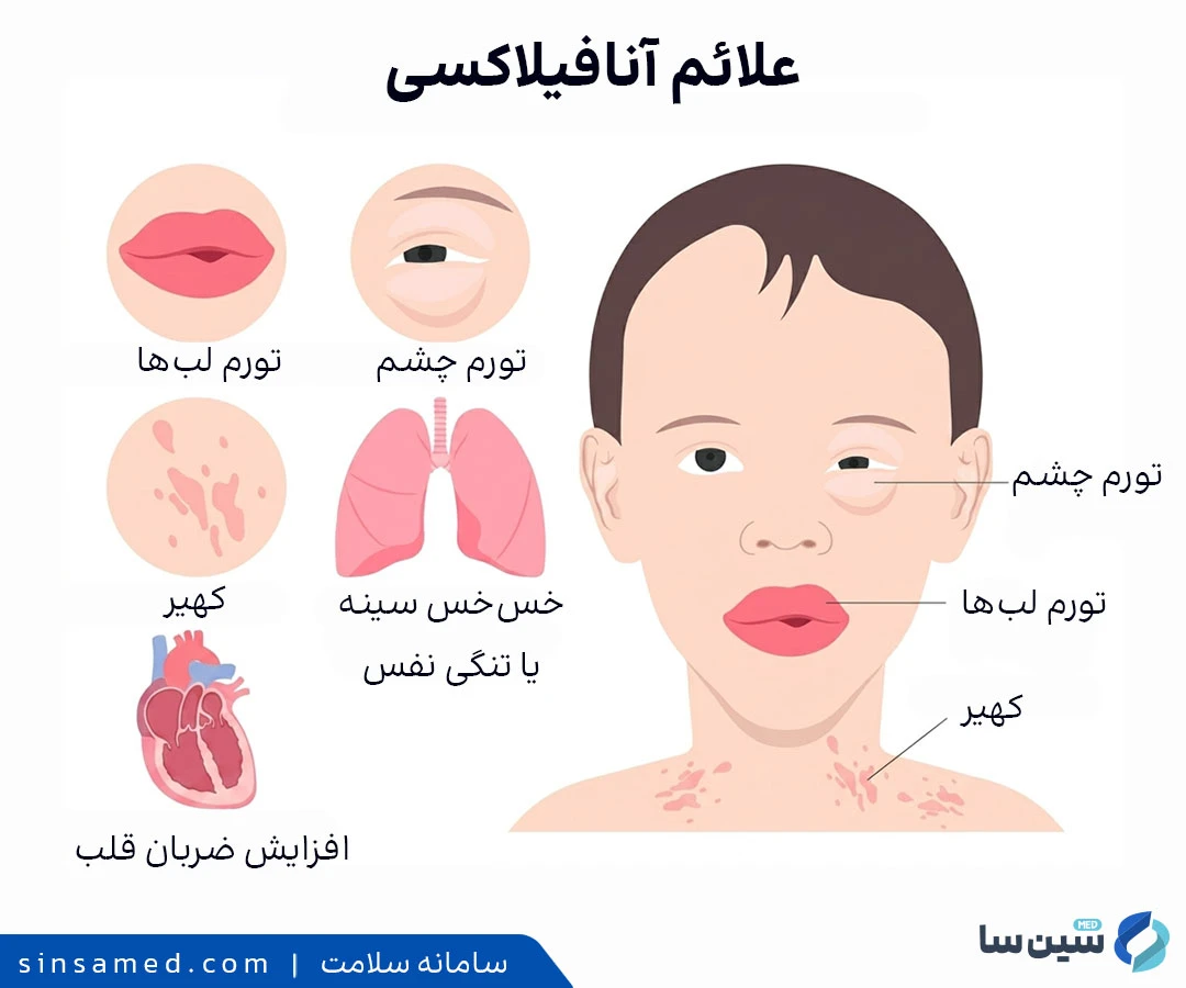 علائم آنافیلاکسی
