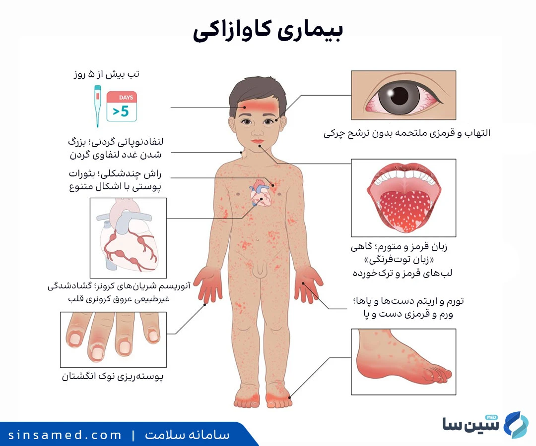 علائم بیماری کاوازاکی