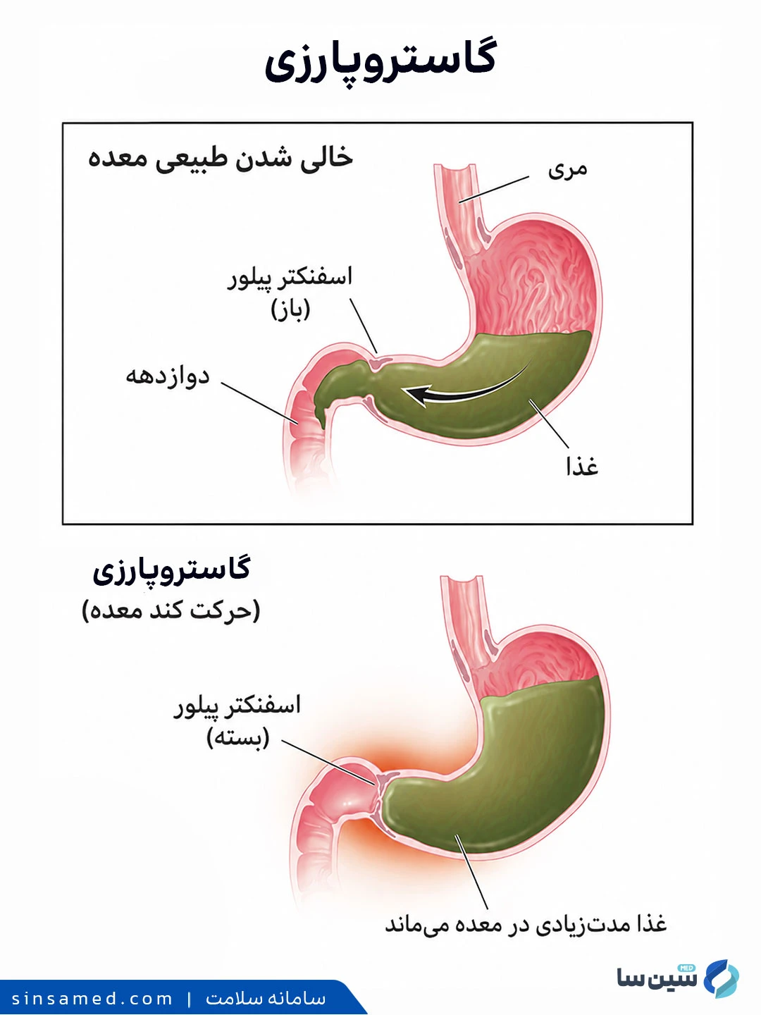 علائم گاستروپارزی